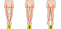Diverse been soorten O-benen, rechte benen en X benen