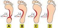 Verschillende voetbogen a, b, c, d